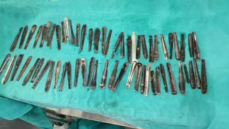 Ινδία: Γιατρός βρήκε σε ασθενή 63 κουτάλια στο στομάχι του